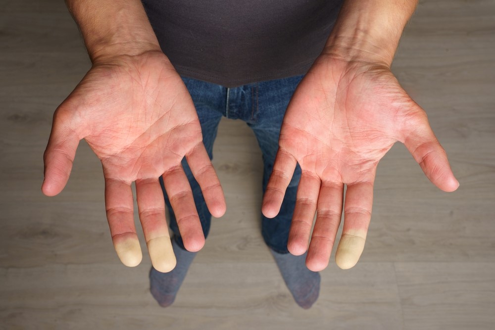 Hands with lost circulation, highlighting Raynaud's