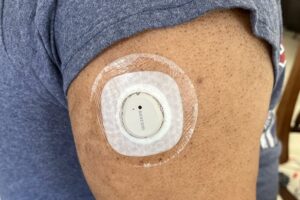 Someone with a Dexcom glucose monitoring patch on their arm, highlighting the idea of Dexcom G7 Medicare coverage